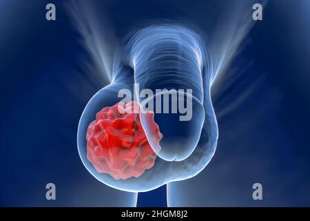 Hodenkrebs, Illustration Stockfoto