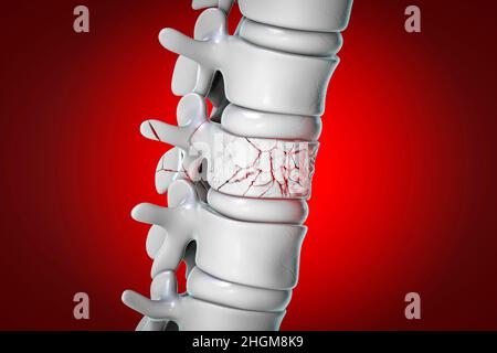 Wirbelsäulenfraktur, Illustration Stockfoto