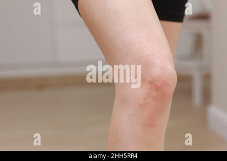 Hautallergien, Beine Haut Frauen. Nahaufnahme von roten Pusteln am Knie, einer allergischen Reaktion, die durch atopische Dermatitis verursacht wird. Ausgewählter Fokus. Stockfoto