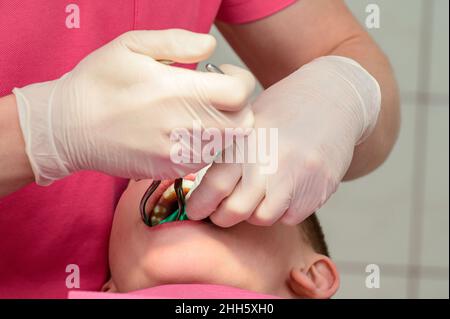 Der Zahnarzt installiert einen Gummidamm und eine Klemme zur Behandlung eines kranken Zahnes, der Junge sitzt in einem Zahnstuhl. Stockfoto