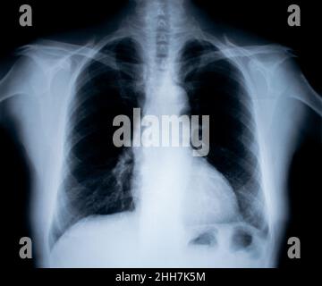Röntgenbild isoliert auf weiß Stockfoto