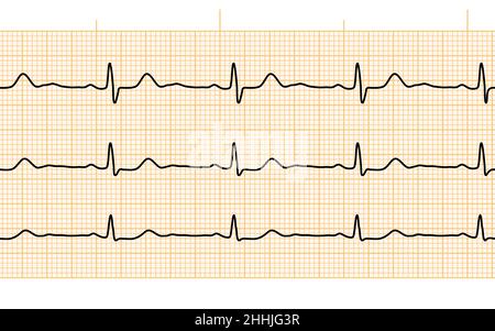 herzschlag-ekg oder ekg nahtlose schwarze Linie auf orangefarbenem Papier. Elektrokardiogramm-Diagramm der Herz-Kreislauf-Heilungsrate. Untersuchung der menschlichen Gesundheit. Medizintest c Stock Vektor