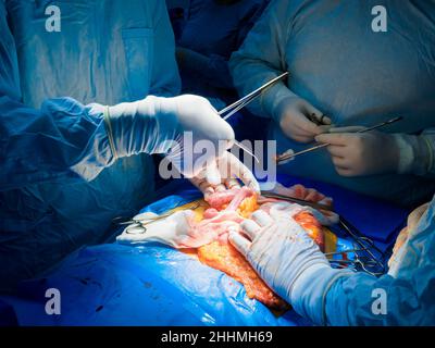 Ein Team von Chirurgen, die eine Bauchoperation an einem Patienten durchführen, um einen Krebs-Tumor im Darm zu entfernen. Selektiver Fokus. Hände von Chirurgen während der Operation an der Bauchhöhle einer Person. Stockfoto