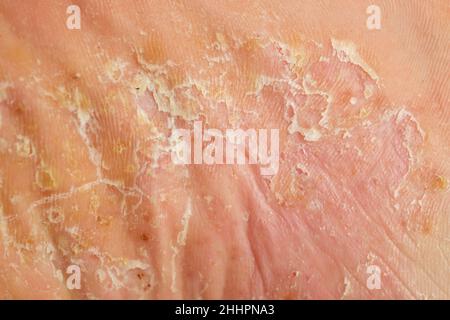 Schwere pustuläre Psoriasis-Läsionen an der Fußsohle Stockfoto