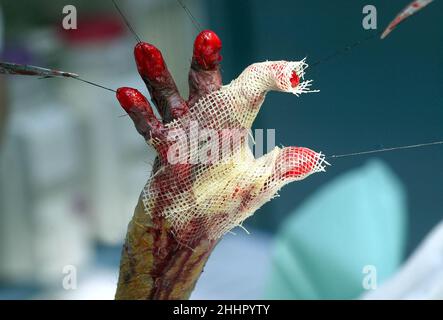 DIE FREIGELASSENE HAND VON GABRIEL SARARU MIT VERBÄNDEN, DEREN ZIFFERN DURCH CHIRURGISCHE STICHE, DIE VON DER ZEPEL IN DEN HÄNDEN DER CHIRURGEN GEHALTEN WERDEN, AUSEINANDER GEHALTEN WERDEN. DIE OPERATION, UM SEINE HAND UND ZIFFERN ZU BEFREIEN, WAR NOTWENDIG, DA SEINE HÄNDE IN DER HAUT, DIE AUFGRUND DES ZUSTANDS DER EPIDERMOLYSIS BULLOSA DYSTROPHICA GEBILDET WURDE, KOKONIERT WURDEN. ER WURDE VOM BRITISCHEN CHIRURGEN OLIVER FENTON OPERIERT, DER JEDES JAHR NACH RUMÄNIEN REIST, UM RUMÄNISCHE KINDER ZU OPERIEREN, UM IHRE MISSBILDUNGEN ZU KORRIGIEREN UND IHNEN EINE BESSERE HOFFNUNG FÜR DIE ZUKUNFT ZU GEBEN. RUMÄNIEN. Bild: GARYROBERTSPHOTOGRAPHY.COM Stockfoto