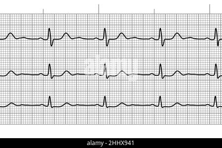 Nahtlose Linie für Herzschlag-ekg oder ekg auf schwarzem und weißem Papier. Elektrokardiogramm-Diagramm der Herz-Kreislauf-Heilungsrate. Untersuchung der menschlichen Gesundheit. Medizin tes Stock Vektor