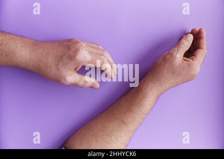 Zeigt Vitiligo Problem Hände auf lila Hintergrund. Pigmentationsproblem der Haut. Hochwertige Fotos Stockfoto