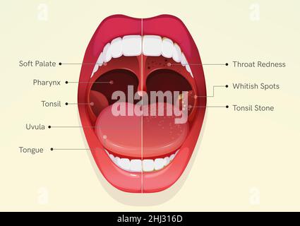 Offener Mund mit Halsschmerzen und Mandelentzündung - Stock Illustration als EPS 10 Datei Stock Vektor