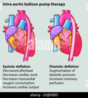 Zwei in einer Serie von drei medizinischen Diagrammen, die zeigen, wie das Herz auf die intraaortische Ballonpumpentherapie anspricht. Pädagogische Biologie Themen Stockfoto