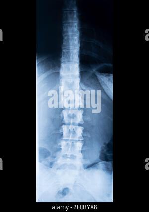 Röntgenaufnahme der menschlichen Wirbelsäule, isoliert auf Schwarz Stockfoto