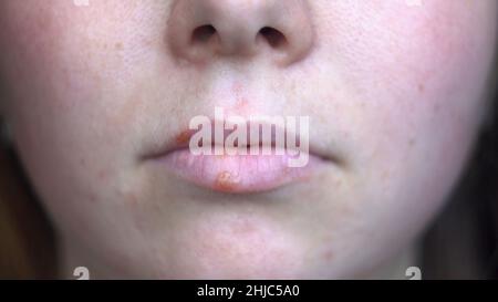 Nahaufnahme von weiblichen Lippen, die mit Herpes-Virus infiziert sind. Konzept der Medizin und Immunologie, unglückliches weibliches Gesicht mit roten Flecken auf den Lippen. Stockfoto