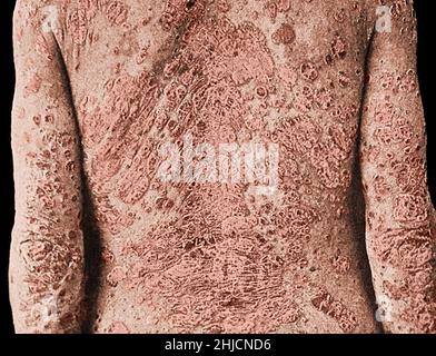 Ein Mann mit schwerer Psoriasis. Historisches Bild. Stockfoto