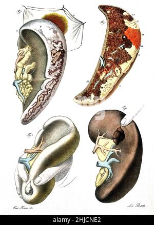 Vier Beispiele für erkrankte Milz. Kolorierte Lithographie von Batelli nach Ferdinando Ferrari, c. 1843. Stockfoto