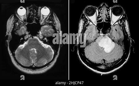 MRT des normalen Gehirns (links) und eines mit akuter Multipler Sklerose (rechts). Auf der linken Seite ist eine MRT-Untersuchung, T2 gewichtete, axiale Ansicht durch das Gehirn einer 54-jährigen Frau. Auf der rechten Seite ist ein axiales MRT-Bild des Gehirns durch die Höhe des Hirnstamms, das ausgedehnte Ödeme und eine Vergrößerung der pons zeigt, die sich in den linken (auf der rechten Seite) mittleren zerebellaren Pedonkel erstreckt. Auf Bildern nach dem Kontrast ist eine markante Ringverbesserung zu sehen. Dies stellt eine Form der akuten MS dar, die einen Tumor stimulieren kann; daher wird sie als tumefaktiv bezeichnet. Stockfoto