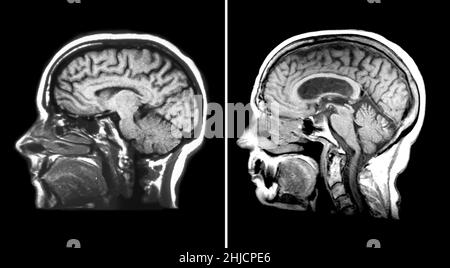Eine der linken ist eine sagittale (von der Seite) T1 gewichtete MRT, die die normale Anatomie des Gehirns zeigt. Auf der rechten Seite befindet sich ein MRT-Bild des Gehirns, das die Vergrößerung der lateralen Ventrikel zeigt, ein Zustand, der Hydrocepalus genannt wird. Diese Anomalie wurde behandelt, indem ein ventrikulärer Shunt-Katheter in die vergrößerten lateralen Ventrikel gelegt wurde, um die Flüssigkeit vom Kopf abzuleiten. Stockfoto