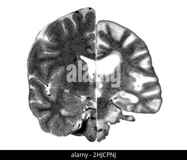 Ein zusammengesetztes Bild, das ein normales koronales (frontales) Querschnitt-MRT-Bild des Gehirns (links) mit einem koronalen MRT-Bild eines Gehirns mit fortgeschrittener Alzheimer-Krankheit (rechts) zeigt. Das erkrankte Gehirn zeigt eine schwere generalisierte Atrophie (Schrumpfung) des Hirngewebes mit einem akzentuierten Gewebeverlust, der die Schläfenlappen einbezieht. Stockfoto