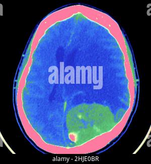 Meningiom, CT-Scan Stockfoto