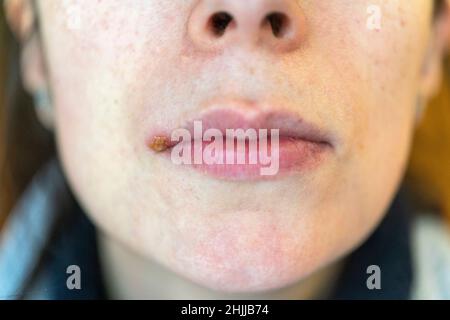 Frau mit Herpes-Simplex-Virus auf der Oberlippe Stockfoto