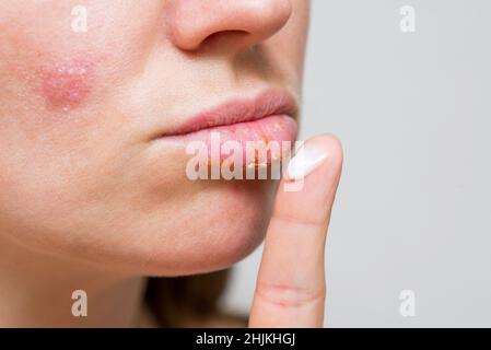 Frau schmiert ihre Wunden auf den Lippen mit Salbe von Herpes-Infektion, Nahaufnahme. Manifestation des Herpesvirus auf den weiblichen Lippen. Stockfoto