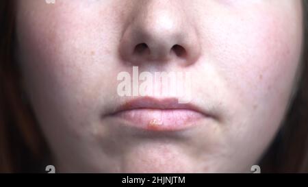 Nahaufnahme der Herpes-Krankheit auf den Lippen eines jungen Mädchens. Weibliche Gesichtsdetails mit den Virusflecken, Konzept der Medizin und Krankheiten. Stockfoto