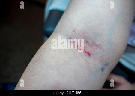 Nahaufnahme des Arms eines kaukasischen Weibchens, nachdem an einem Tag zweimal Blut aus derselben Vene entnommen wurde, was zu schweren Hautreizungen führt Stockfoto