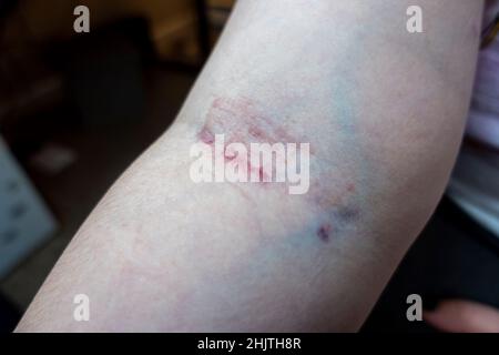 Nahaufnahme des Arms eines kaukasischen Weibchens, nachdem an einem Tag zweimal Blut aus derselben Vene entnommen wurde, was zu schweren Hautreizungen führt Stockfoto