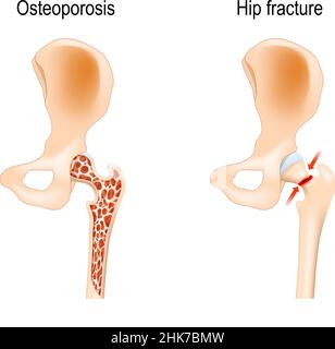 Alterungsprozess in den menschlichen Knochen. Osteoporose, die von Hüftfraktur verursacht. vektor-Illustration. Medizinisches Poster Stock Vektor