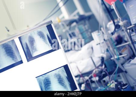 Radiologische Kontrollbilder auf dem Negatoskop auf der Patientenstation. Stockfoto