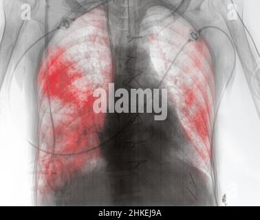 Röntgenbild eines Patienten mit Lungenentzündung in der frühen postoperativen Phase. Stockfoto