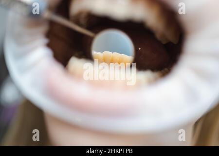 Nahaufnahme des offenen Mundes einer Patientin während der ärztlichen Untersuchung. Makroaufnahme der Spiegelung der Zähne im Zahnarztspiegel Stockfoto