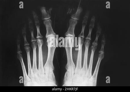 Röntgenaufnahme der Füße, Valgusdeformität der Zehe oder eines Knochens am Finger, 3rd Grad. Orthopädische Erkrankung. Stockfoto