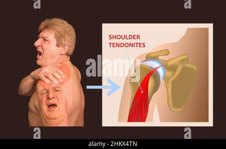 Schultergelenkstruktur und Schultertendonitis. Die Collage eines älteren Mannes mit Schulterschmerzen auf schwarzem Hintergrund. Gesundheitskonzept Stockfoto