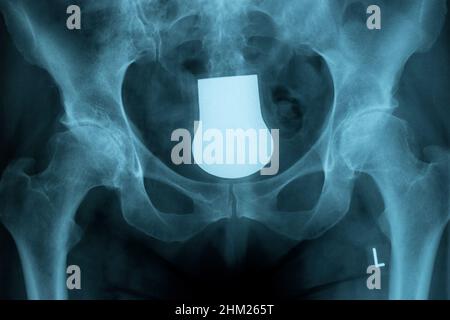 X-ray des Beckens und der Wirbelsäule einer Frau Stockfoto