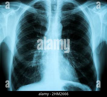 Röntgenbild der MR-Tomographie der gesunden menschlichen Brust Stockfoto