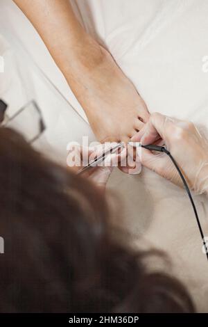 Der Prozess der dauerhaften Entfernung unerwünschter Haare an den Zehen mit einem Elektroepiliergerät und einer Pinzette. Stockfoto