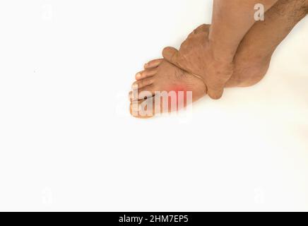 Fußerkrankung Rheuma und Gicht. Schwellung des roten Beins. Schmerzen im Fuß Stockfoto