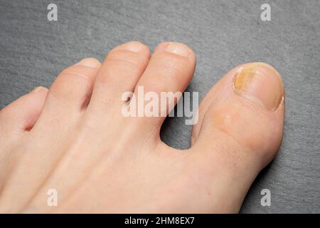 Zehennägel mit Pilzproblemen, Onychomykose, auch bekannt als Tinea unguium, ist eine Pilzinfektion des Nagels, grauer Hintergrund. Stockfoto