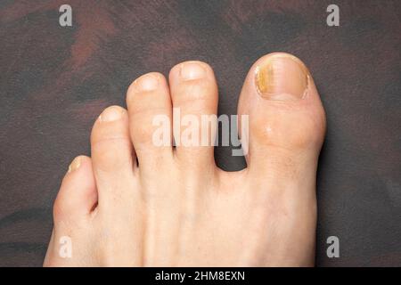 Zehennägel mit Pilzproblemen, Onychomykose, auch bekannt als Tinea unguium, ist eine Pilzinfektion des Nagels, dunkler Hintergrund. Stockfoto