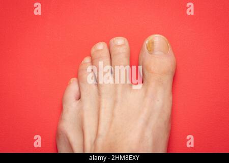 Zehennägel mit Pilzproblemen, Onychomykose, auch bekannt als Tinea unguium, ist eine Pilzinfektion des Nagels, roter Hintergrund. Stockfoto