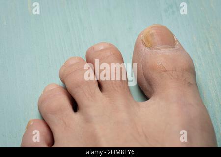 Zehennägel mit Pilzproblemen, Onychomykose, auch bekannt als Tinea unguium, ist eine Pilzinfektion des Nagels, grüner Hintergrund. Stockfoto