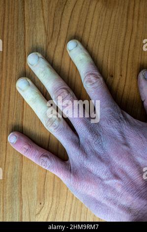 Eine erfrorene männliche Hand mit Raynaud-Syndrom, Raynaud-Phänomen oder Raynaud-Krankheit. Stockfoto