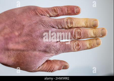 Eine erfrorene männliche Hand mit Raynaud-Syndrom, Raynaud-Phänomen oder Raynaud-Krankheit. Stockfoto