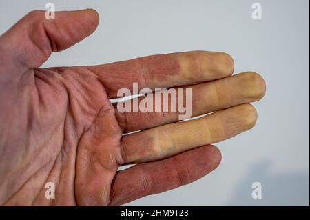 Eine erfrorene männliche Hand mit Raynaud-Syndrom, Raynaud-Phänomen oder Raynaud-Krankheit. Stockfoto