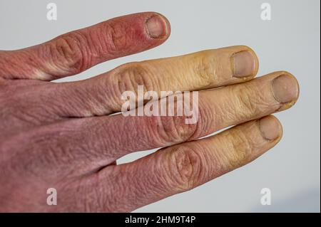 Eine erfrorene männliche Hand mit Raynaud-Syndrom, Raynaud-Phänomen oder Raynaud-Krankheit. Stockfoto