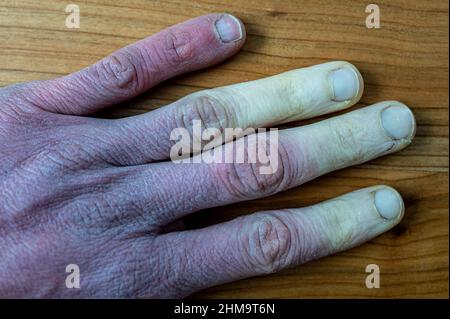 Eine erfrorene männliche Hand mit Raynaud-Syndrom, Raynaud-Phänomen oder Raynaud-Krankheit. Stockfoto