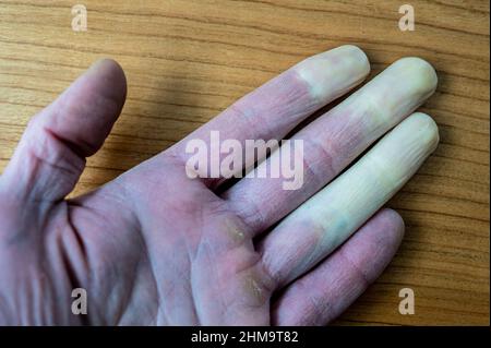 Eine erfrorene männliche Hand mit Raynaud-Syndrom, Raynaud-Phänomen oder Raynaud-Krankheit. Stockfoto