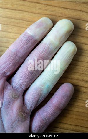 Eine erfrorene männliche Hand mit Raynaud-Syndrom, Raynaud-Phänomen oder Raynaud-Krankheit. Stockfoto