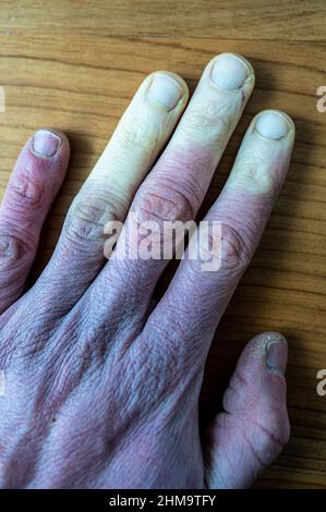 Eine erfrorene männliche Hand mit Raynaud-Syndrom, Raynaud-Phänomen oder Raynaud-Krankheit. Stockfoto