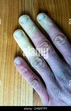 Eine erfrorene männliche Hand mit Raynaud-Syndrom, Raynaud-Phänomen oder Raynaud-Krankheit. Stockfoto