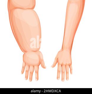 Ödem geschwollene Hand oder Arm. Lymphodem, Eodema-Krankheitsvektor. Cartoon menschlichen Körper Unterarme und Hände, geschwollene und gesunde Arme, Finger, Handgelenke und elb Stock Vektor